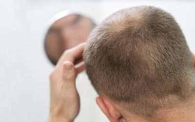 Causas de Alopecia